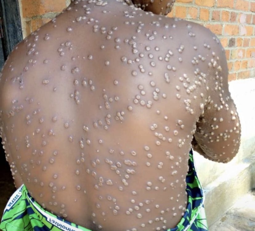 Mpox in Kenya