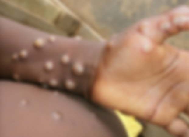 monkeypox vaccines